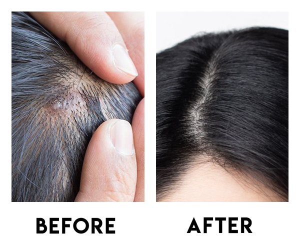 Scalp Acne Removal Treatment Singapore | Try for $28