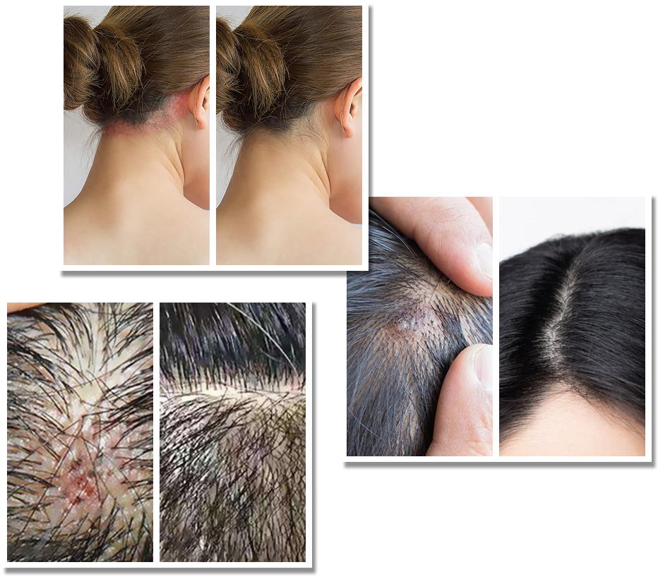 Scalp Acne Removal Treatment Singapore | Try for $28