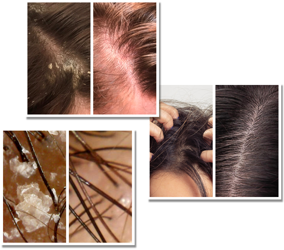 Scalp Itch Control Treatment Singapore | Try for $28